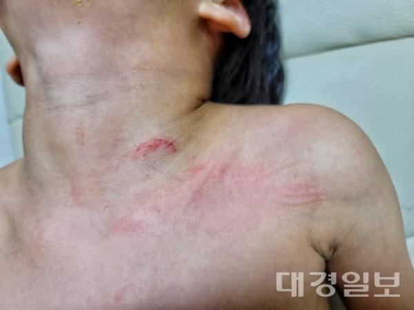 ▲ 포항시 남구 근로복지공단 어린이집 교사로 부터 폭행 당한 6살 B군의 상처 부위.